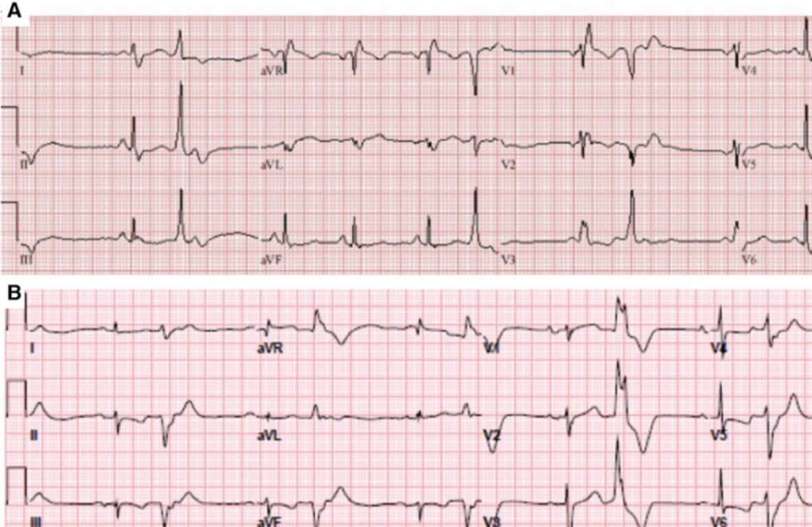 Ablación de Arritmias